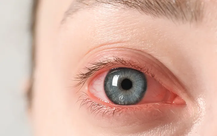 Symptome allergische Reaktion Ein grötetes Auge